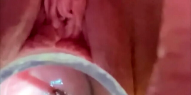 Hegar Sound Probing Deep In Cervix