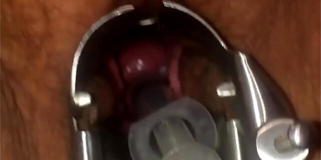 Artificial Insemination Putting Cum In Cervix